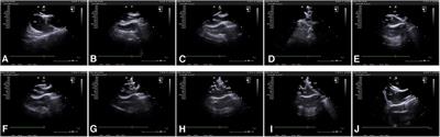 Efficacy and safety of transesophageal ultrasound-guided patent foramen ovale closure for migraine in adolescents